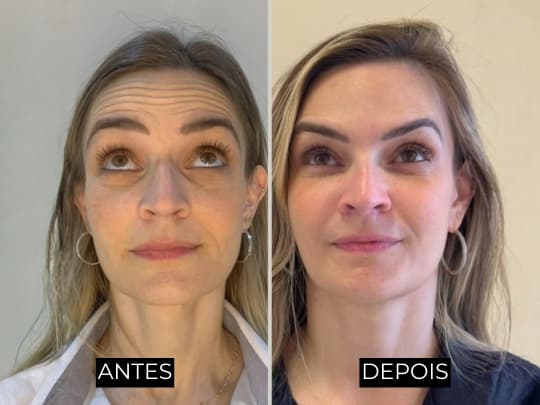 Antes e depois de harmonização facial - caso 2