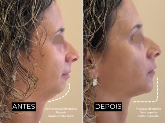 Antes e depois de harmonização facial - caso 4