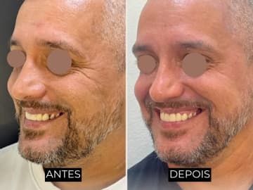 Antes e depois de harmonização facial - caso 5